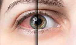 Bulaşıcı ‘kırmızı göz’ hastalığı hızla yayılıyor: Sayı 86 bini geçti