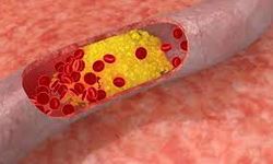 Kolesterol nasıl düşürülür? Uzman anlatıyor…