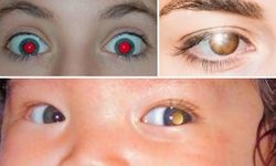 Fotoğraflarda gözlerin kırmızı, sarı veya beyaz çıkması ne anlama gelir?
