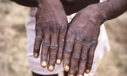 Acil durum ilan edildi! Afrika'da maymun çiçeği salgını