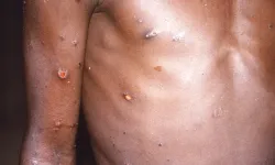 İsveç'ten sonra Pakistan'da da maymun çiçeği görüldü