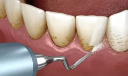 Evde Doğal ve Kolay Yöntemlerle Diş Taşı Temizleme: Diş Taşı Nasıl Temizlenir?