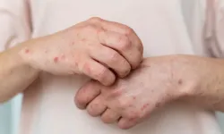 Aydın’da uyuz salgını uyarısı