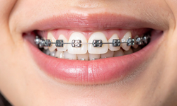 Diş Teli Fiyatları 2025: Hangi Tedavi Daha Uygun Fiyatlı?