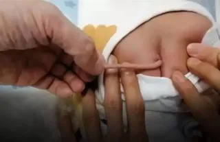 Kuyrukla dünyaya gelen bebek şoke etti! Doktorlar nedenini açıkladı