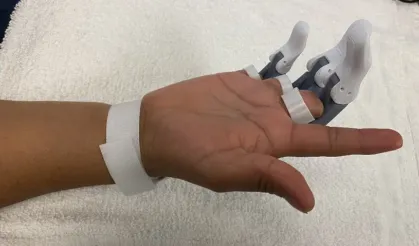 3D yazıcı ile parmak protezi yaptılar