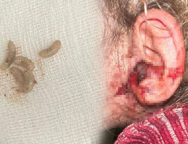 3 yaşındaki çocuğun kulağından 23 adet canlı kurtçuk çıkartıldı