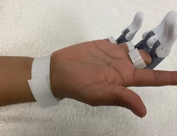 3D yazıcı ile parmak protezi yaptılar