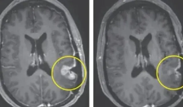 Bilim insanlarından çığır açan tedavi: Beyin tümörü beş gün içinde yok edilebilecek