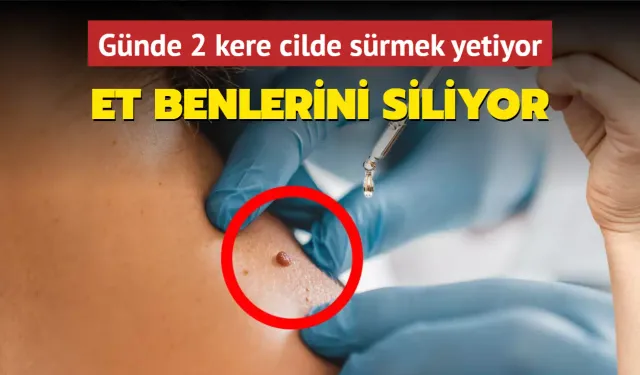 Et benlerinden kurtulmak bu kadar kolay! Günde 2 kere cilde sürmek yetiyor