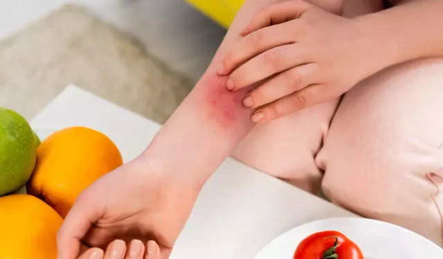 Kaşıntıya elma, iltihaba domates deneyin! İşte alerjiye iyi gelen besinler