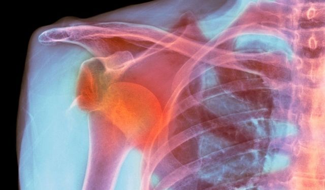 Omuz Çıkığı Ameliyatı: Tekrarlayan Çıkıklar ve Kalıcı Çözüm Yolları